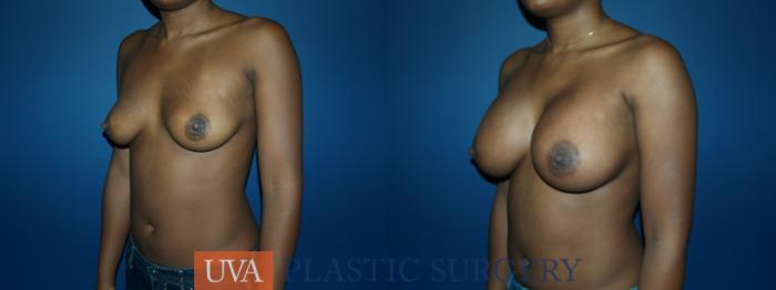 Breast Augmentation Case 55 Before & After View #4 | Richmond, Charlottesville & Roanoke, VA | University of Virginia Plastic Surgery