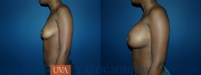 Breast Augmentation Case 55 Before & After View #5 | Richmond, Charlottesville & Roanoke, VA | University of Virginia Plastic Surgery