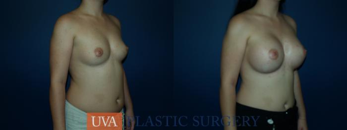 Breast Augmentation Case 56 Before & After View #2 | Richmond, Charlottesville & Roanoke, VA | University of Virginia Plastic Surgery