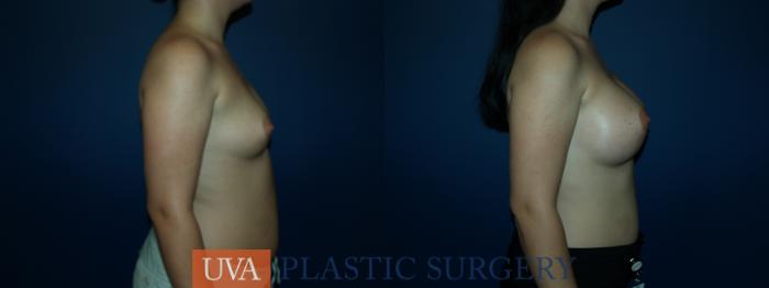 Breast Augmentation Case 56 Before & After View #3 | Richmond, Charlottesville & Roanoke, VA | University of Virginia Plastic Surgery