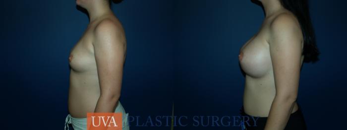 Breast Augmentation Case 56 Before & After View #5 | Richmond, Charlottesville & Roanoke, VA | University of Virginia Plastic Surgery