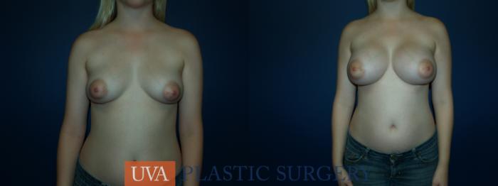 Breast Augmentation Case 57 Before & After View #1 | Richmond, Charlottesville & Roanoke, VA | University of Virginia Plastic Surgery