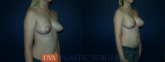 Breast Augmentation Case 57 Before & After View #2 | Richmond, Charlottesville & Roanoke, VA | University of Virginia Plastic Surgery