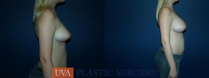 Breast Augmentation Case 57 Before & After View #3 | Richmond, Charlottesville & Roanoke, VA | University of Virginia Plastic Surgery