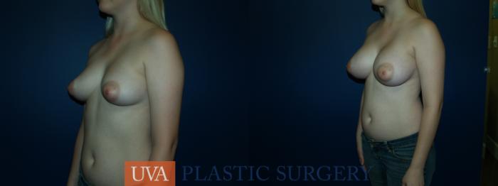 Breast Augmentation Case 57 Before & After View #4 | Richmond, Charlottesville & Roanoke, VA | University of Virginia Plastic Surgery