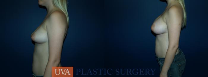 Breast Augmentation Case 57 Before & After View #5 | Richmond, Charlottesville & Roanoke, VA | University of Virginia Plastic Surgery