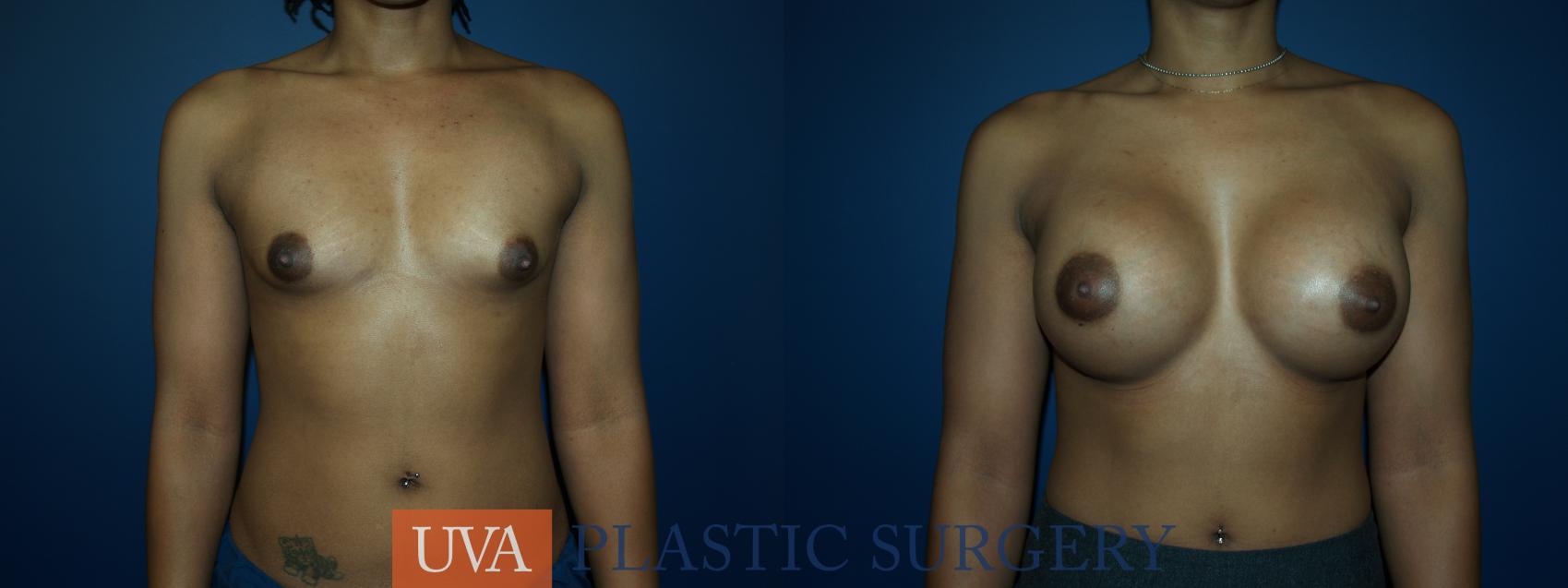 Breast Augmentation Case 59 Before & After View #1 | Charlottesville & Fishersville, VA | University of Virginia Plastic Surgery