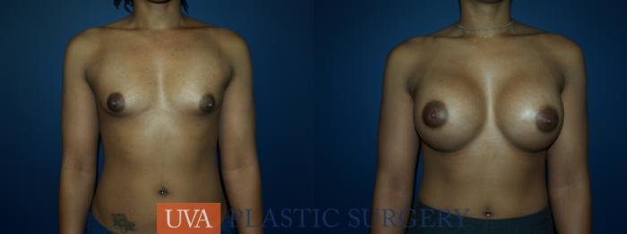 Breast Augmentation Case 59 Before & After View #1 | Richmond, Charlottesville & Roanoke, VA | University of Virginia Plastic Surgery