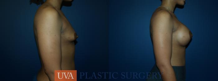 Breast Augmentation Case 59 Before & After View #3 | Richmond, Charlottesville & Roanoke, VA | University of Virginia Plastic Surgery