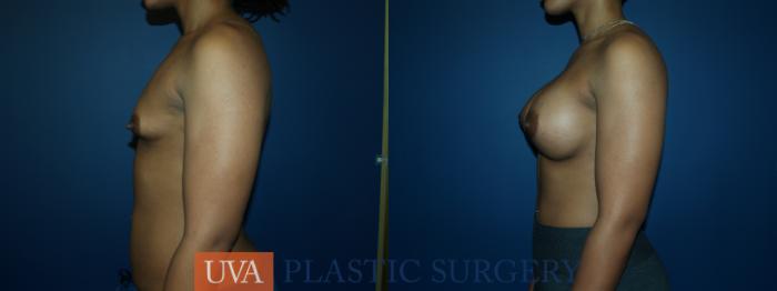 Breast Augmentation Case 59 Before & After View #5 | Richmond, Charlottesville & Roanoke, VA | University of Virginia Plastic Surgery