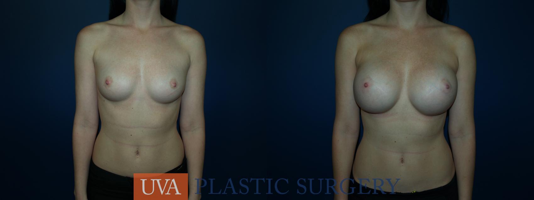 Breast Augmentation Case 62 Before & After View #1 | Richmond, Charlottesville & Roanoke, VA | University of Virginia Plastic Surgery