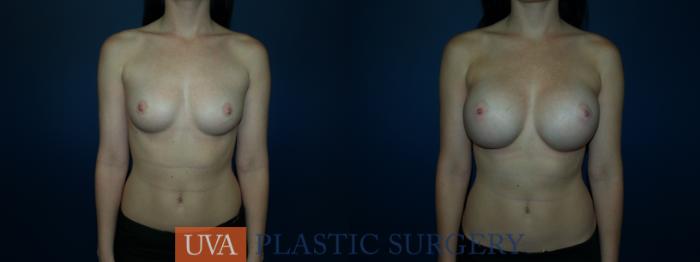 Breast Augmentation Case 62 Before & After View #1 | Richmond, Charlottesville & Roanoke, VA | University of Virginia Plastic Surgery