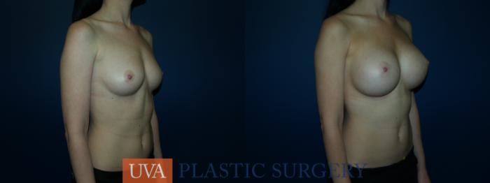 Breast Augmentation Case 62 Before & After View #2 | Richmond, Charlottesville & Roanoke, VA | University of Virginia Plastic Surgery