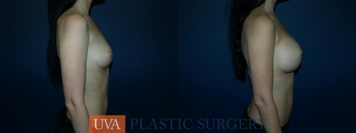 Breast Augmentation Case 62 Before & After View #3 | Richmond, Charlottesville & Roanoke, VA | University of Virginia Plastic Surgery