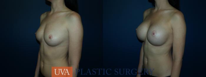 Breast Augmentation Case 62 Before & After View #4 | Richmond, Charlottesville & Roanoke, VA | University of Virginia Plastic Surgery