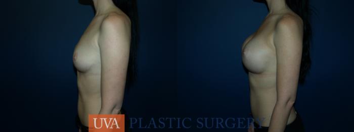 Breast Augmentation Case 62 Before & After View #5 | Richmond, Charlottesville & Roanoke, VA | University of Virginia Plastic Surgery
