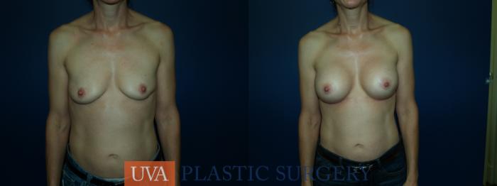 Breast Augmentation Case 63 Before & After View #1 | Richmond, Charlottesville & Roanoke, VA | University of Virginia Plastic Surgery