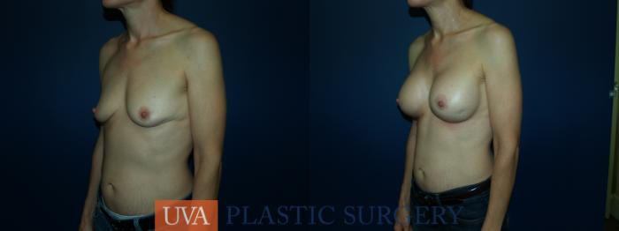 Breast Augmentation Case 63 Before & After View #2 | Richmond, Charlottesville & Roanoke, VA | University of Virginia Plastic Surgery