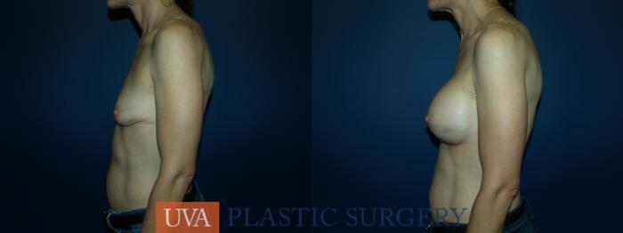 Breast Augmentation Case 63 Before & After View #5 | Richmond, Charlottesville & Roanoke, VA | University of Virginia Plastic Surgery