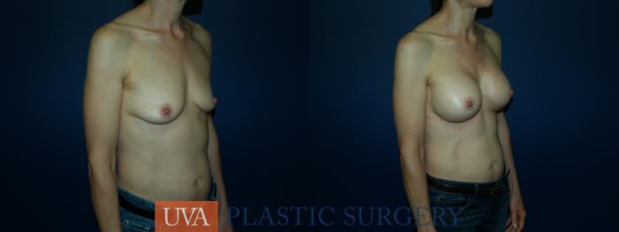 Breast Augmentation Case 63 Before & After View #6 | Richmond, Charlottesville & Roanoke, VA | University of Virginia Plastic Surgery