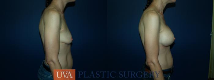 Breast Augmentation Case 63 Before & After View #7 | Richmond, Charlottesville & Roanoke, VA | University of Virginia Plastic Surgery