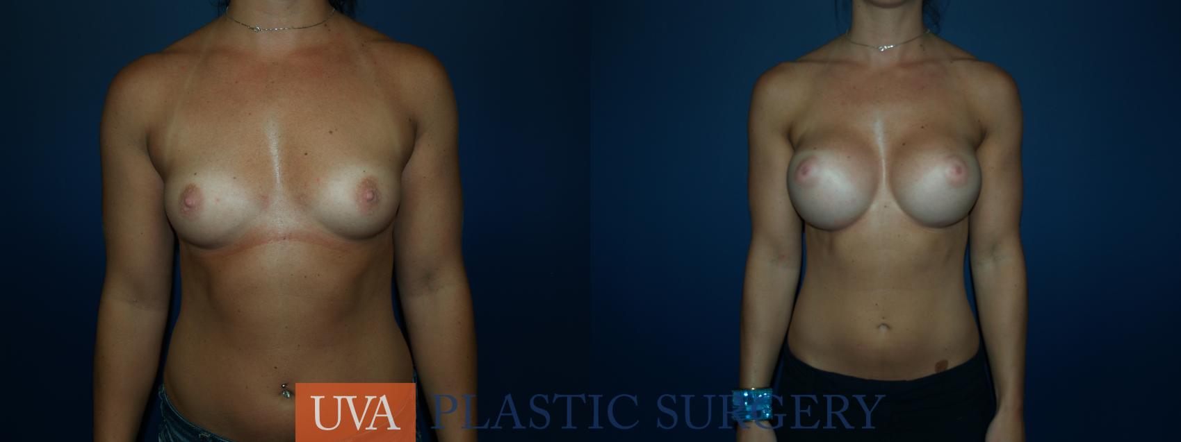 Breast Augmentation Case 64 Before & After View #1 | Richmond, Charlottesville & Roanoke, VA | University of Virginia Plastic Surgery