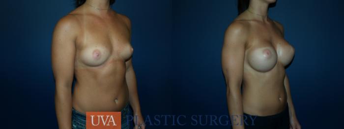 Breast Augmentation Case 64 Before & After View #2 | Richmond, Charlottesville & Roanoke, VA | University of Virginia Plastic Surgery