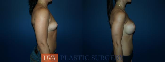 Breast Augmentation Case 64 Before & After View #3 | Richmond, Charlottesville & Roanoke, VA | University of Virginia Plastic Surgery