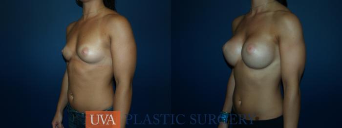 Breast Augmentation Case 64 Before & After View #4 | Richmond, Charlottesville & Roanoke, VA | University of Virginia Plastic Surgery
