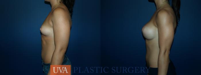 Breast Augmentation Case 64 Before & After View #5 | Richmond, Charlottesville & Roanoke, VA | University of Virginia Plastic Surgery