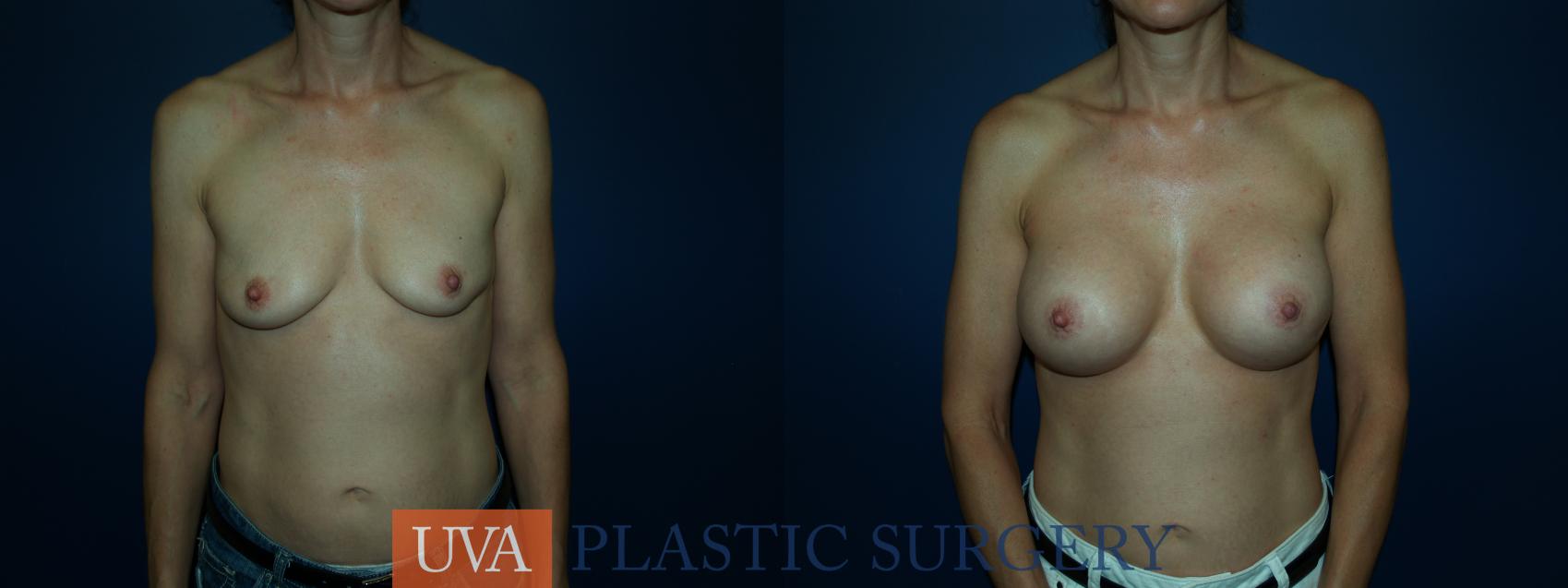 Breast Augmentation Case 66 Before & After View #1 | Richmond, Charlottesville & Roanoke, VA | University of Virginia Plastic Surgery