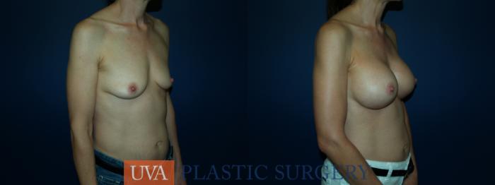 Breast Augmentation Case 66 Before & After View #2 | Richmond, Charlottesville & Roanoke, VA | University of Virginia Plastic Surgery
