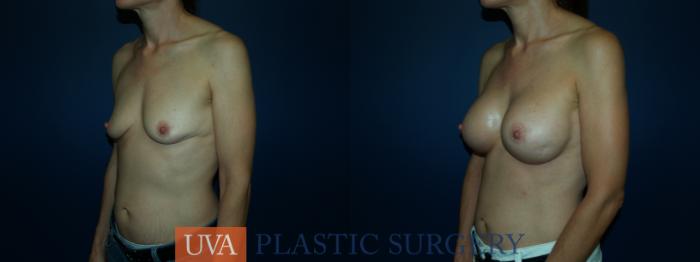 Breast Augmentation Case 66 Before & After View #4 | Richmond, Charlottesville & Roanoke, VA | University of Virginia Plastic Surgery