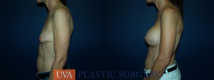 Breast Augmentation Case 66 Before & After View #5 | Richmond, Charlottesville & Roanoke, VA | University of Virginia Plastic Surgery