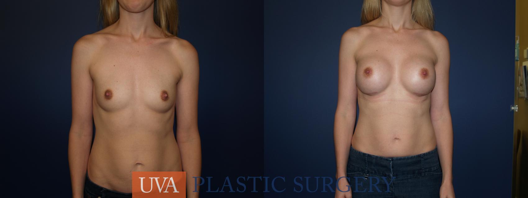 Breast Augmentation Case 69 Before & After View #1 | Richmond, Charlottesville & Roanoke, VA | University of Virginia Plastic Surgery
