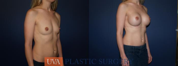 Breast Augmentation Case 69 Before & After View #2 | Richmond, Charlottesville & Roanoke, VA | University of Virginia Plastic Surgery