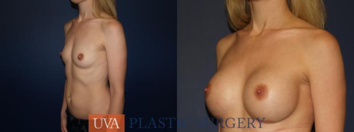 Breast Augmentation Case 69 Before & After View #4 | Richmond, Charlottesville & Roanoke, VA | University of Virginia Plastic Surgery