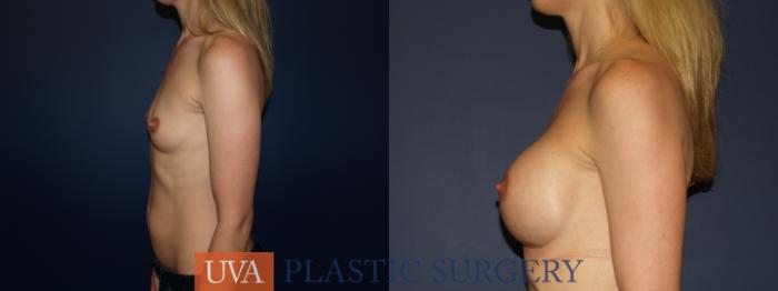 Breast Augmentation Case 69 Before & After View #5 | Richmond, Charlottesville & Roanoke, VA | University of Virginia Plastic Surgery