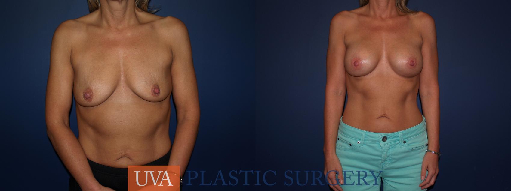 Breast Augmentation Case 70 Before & After View #1 | Charlottesville & Fishersville, VA | University of Virginia Plastic Surgery