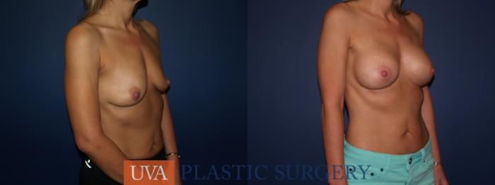Breast Augmentation Case 70 Before & After View #2 | Charlottesville & Fishersville, VA | University of Virginia Plastic Surgery