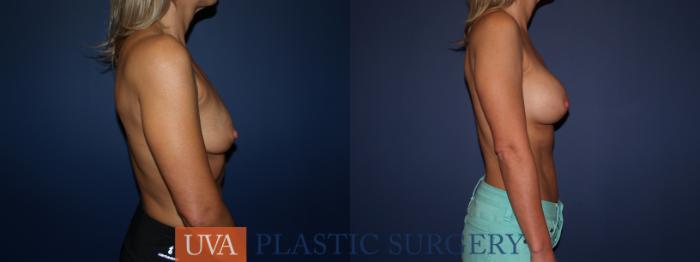 Breast Augmentation Case 70 Before & After View #3 | Charlottesville & Fishersville, VA | University of Virginia Plastic Surgery