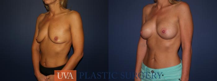 Breast Augmentation Case 70 Before & After View #4 | Charlottesville & Fishersville, VA | University of Virginia Plastic Surgery