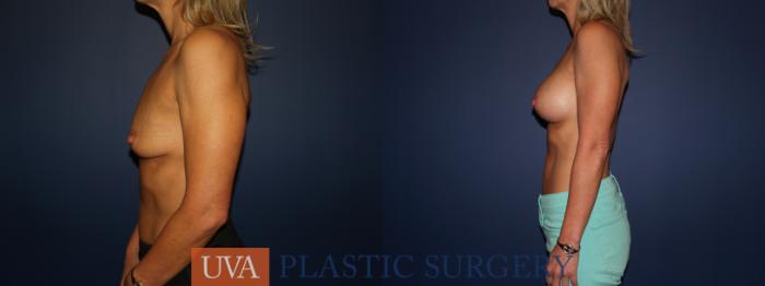 Breast Augmentation Case 70 Before & After View #5 | Charlottesville & Fishersville, VA | University of Virginia Plastic Surgery
