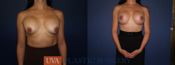 Breast Augmentation Case 71 Before & After View #1 | Charlottesville & Fishersville, VA | University of Virginia Plastic Surgery