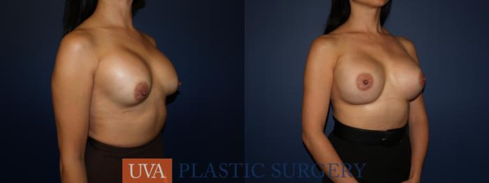 Breast Augmentation Case 71 Before & After View #2 | Charlottesville & Fishersville, VA | University of Virginia Plastic Surgery