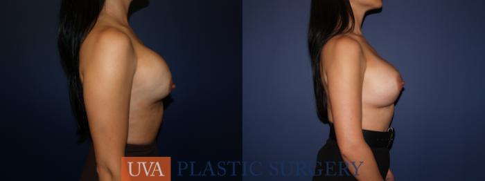 Breast Augmentation Case 71 Before & After View #3 | Charlottesville & Fishersville, VA | University of Virginia Plastic Surgery