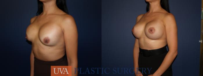 Breast Augmentation Case 71 Before & After View #4 | Charlottesville & Fishersville, VA | University of Virginia Plastic Surgery