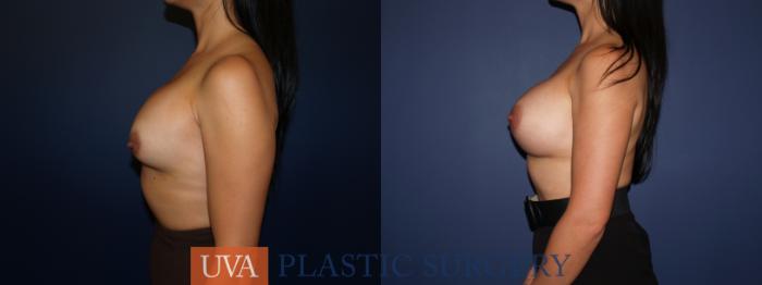 Breast Augmentation Case 71 Before & After View #5 | Charlottesville & Fishersville, VA | University of Virginia Plastic Surgery