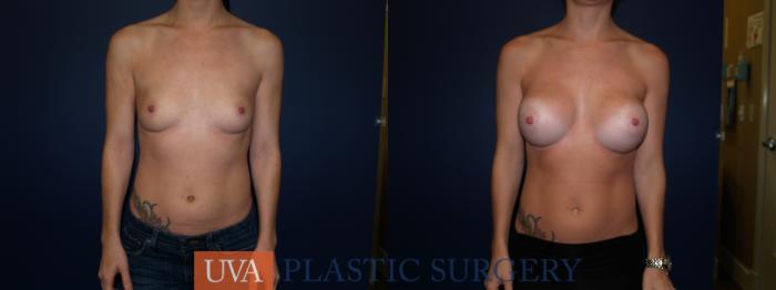 Breast Augmentation Case 72 Before & After View #1 | Richmond, Charlottesville & Roanoke, VA | University of Virginia Plastic Surgery
