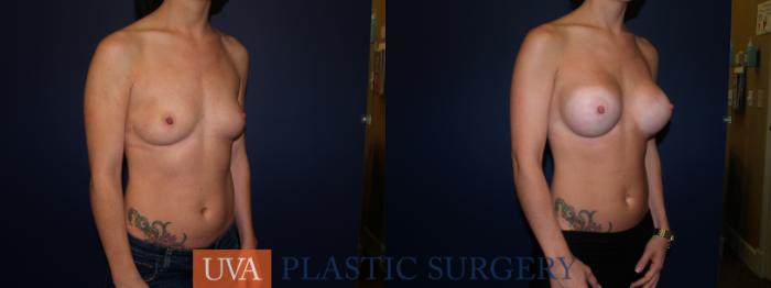 Breast Augmentation Case 72 Before & After View #2 | Richmond, Charlottesville & Roanoke, VA | University of Virginia Plastic Surgery